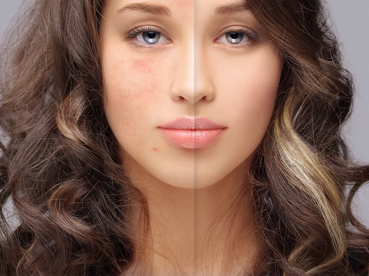 Genius acne scars