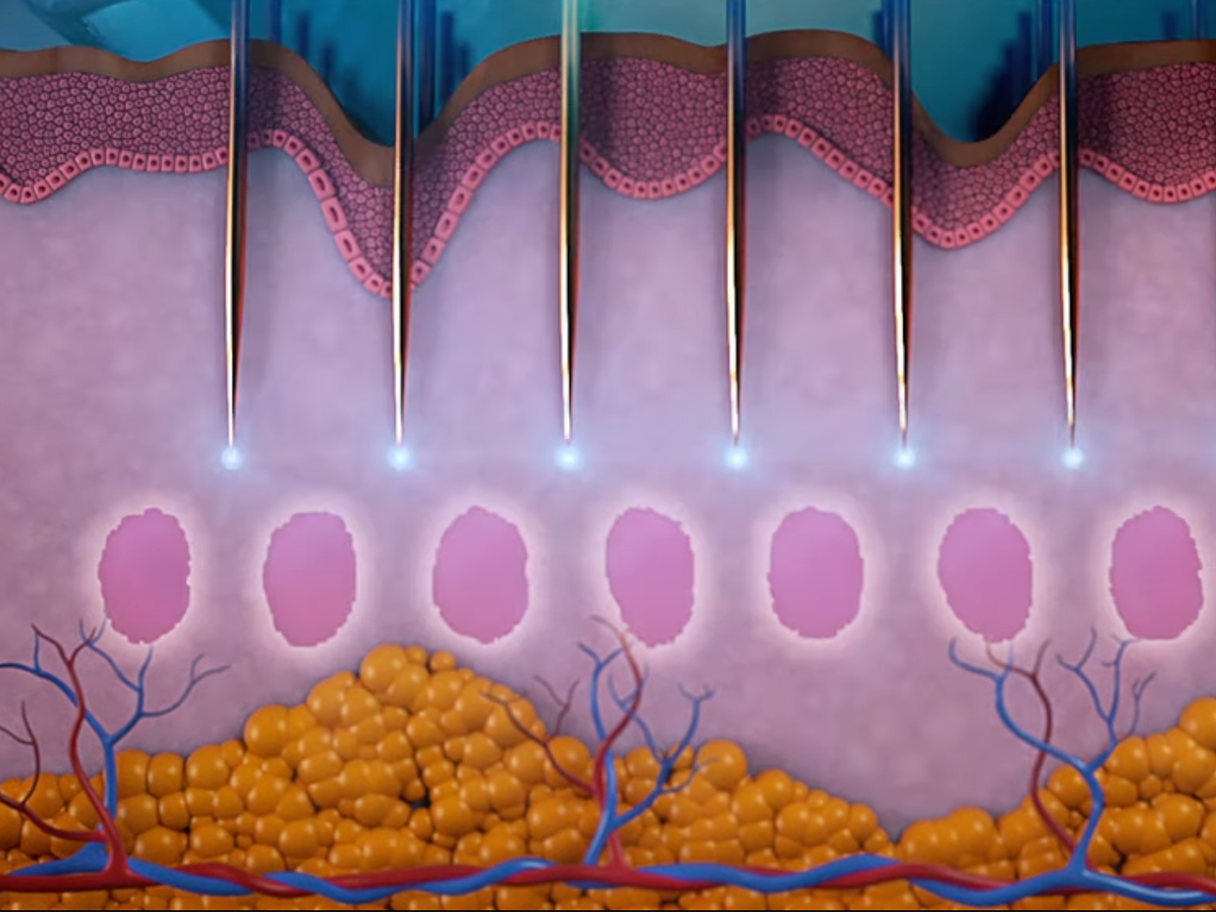 Genius Radiofrequency